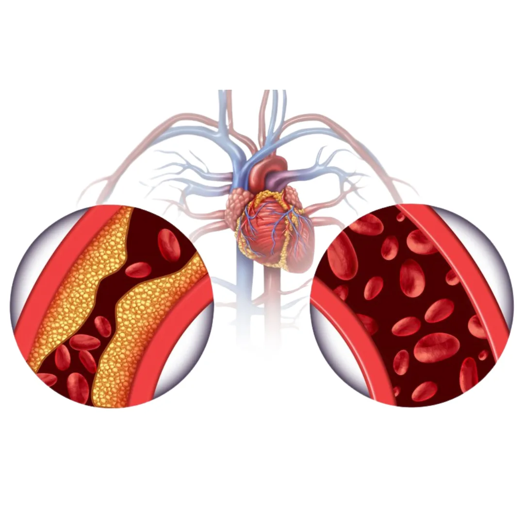 Miażdżyca – cichy zabójca. Sprawdź, jakie badania wykonać
