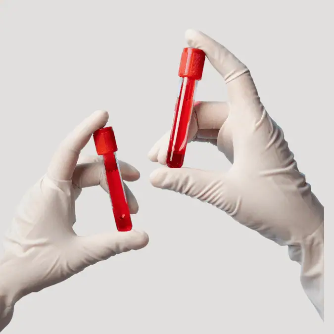 Test na hemochromatozę próbka krwi w probówce laboratoryjnej.